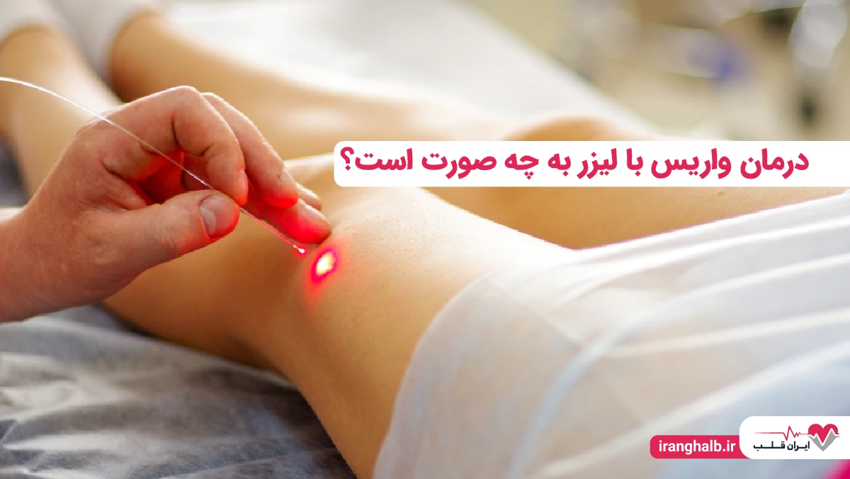 درمان واریس با لیزر به چه صورت است؟