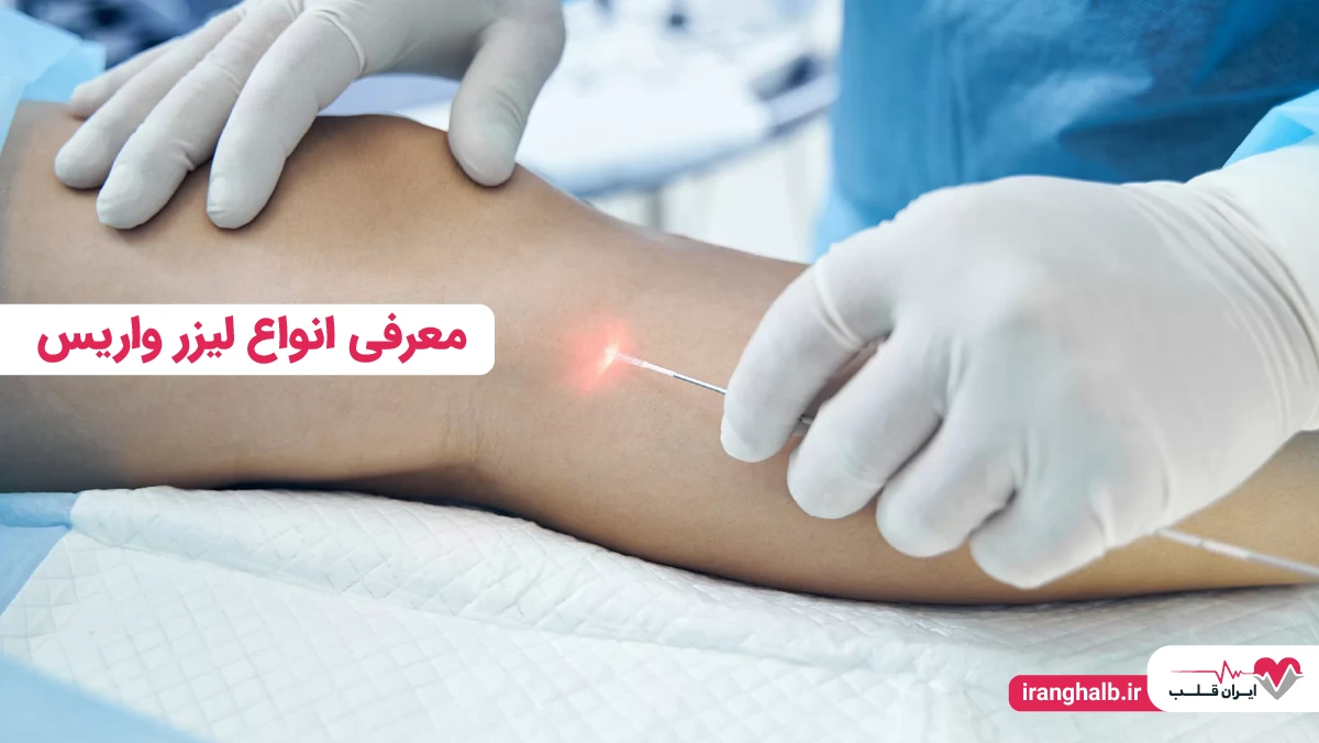 معرفی انواع لیزر واریس
