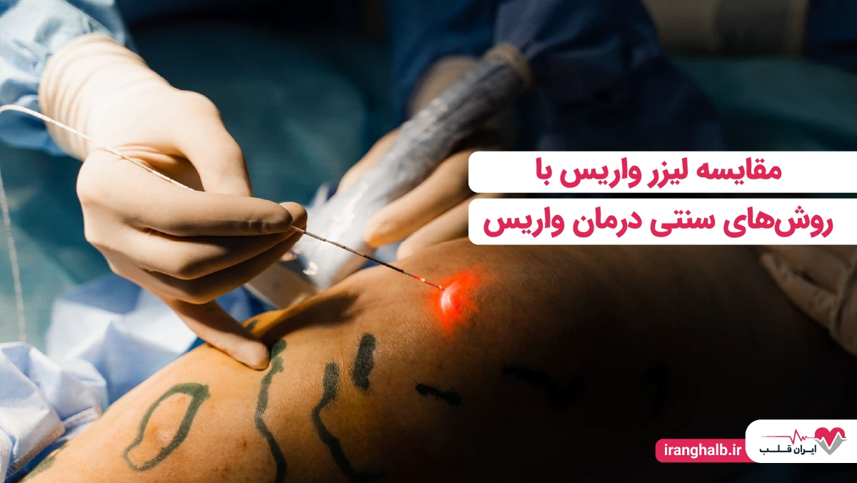 مقایسه لیزر واریس با روشهای سنتی درمان واریس