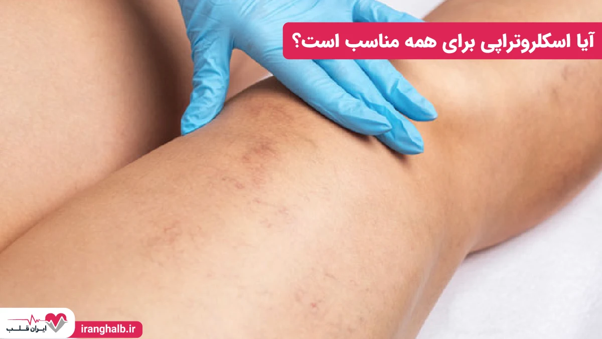 آیا اسکلروتراپی برای همه مناسب است؟ آیا اسکلروتراپی برای همه مناسب است؟