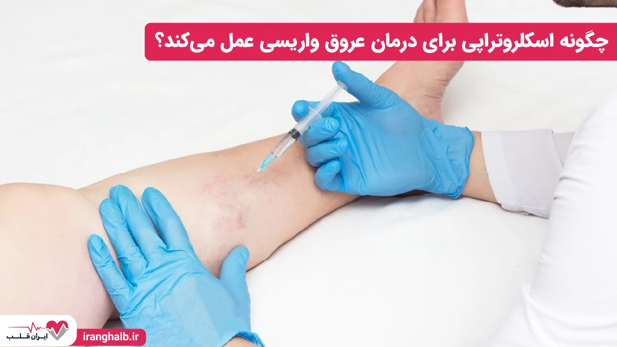 چگونه اسکلروتراپی برای درمان عروق واریسی عمل میکند؟ چگونه اسکلروتراپی برای درمان عروق واریسی عمل میکند؟