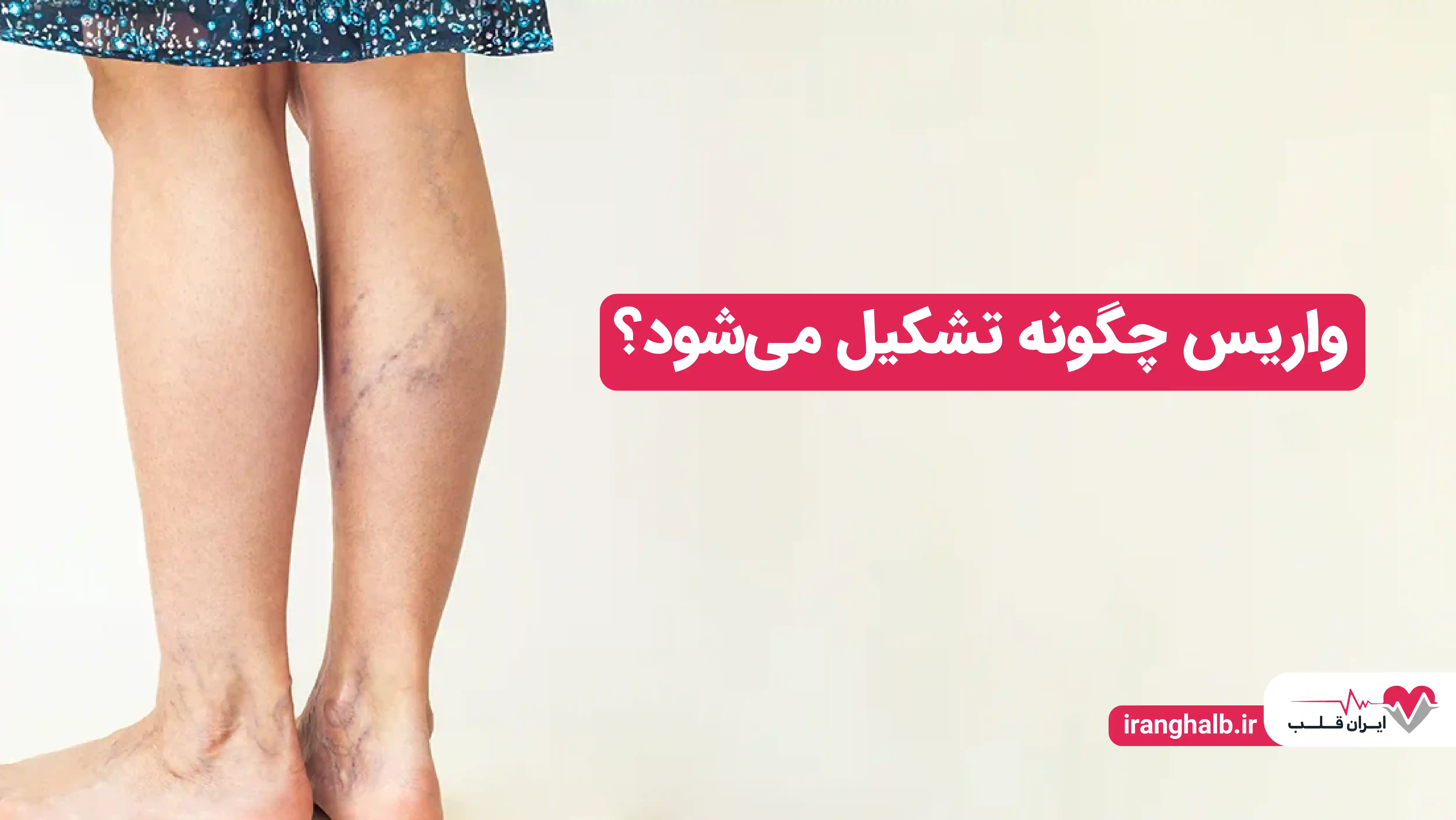 واریس چگونه تشکیل میشود؟ واریس چگونه تشکیل میشود؟