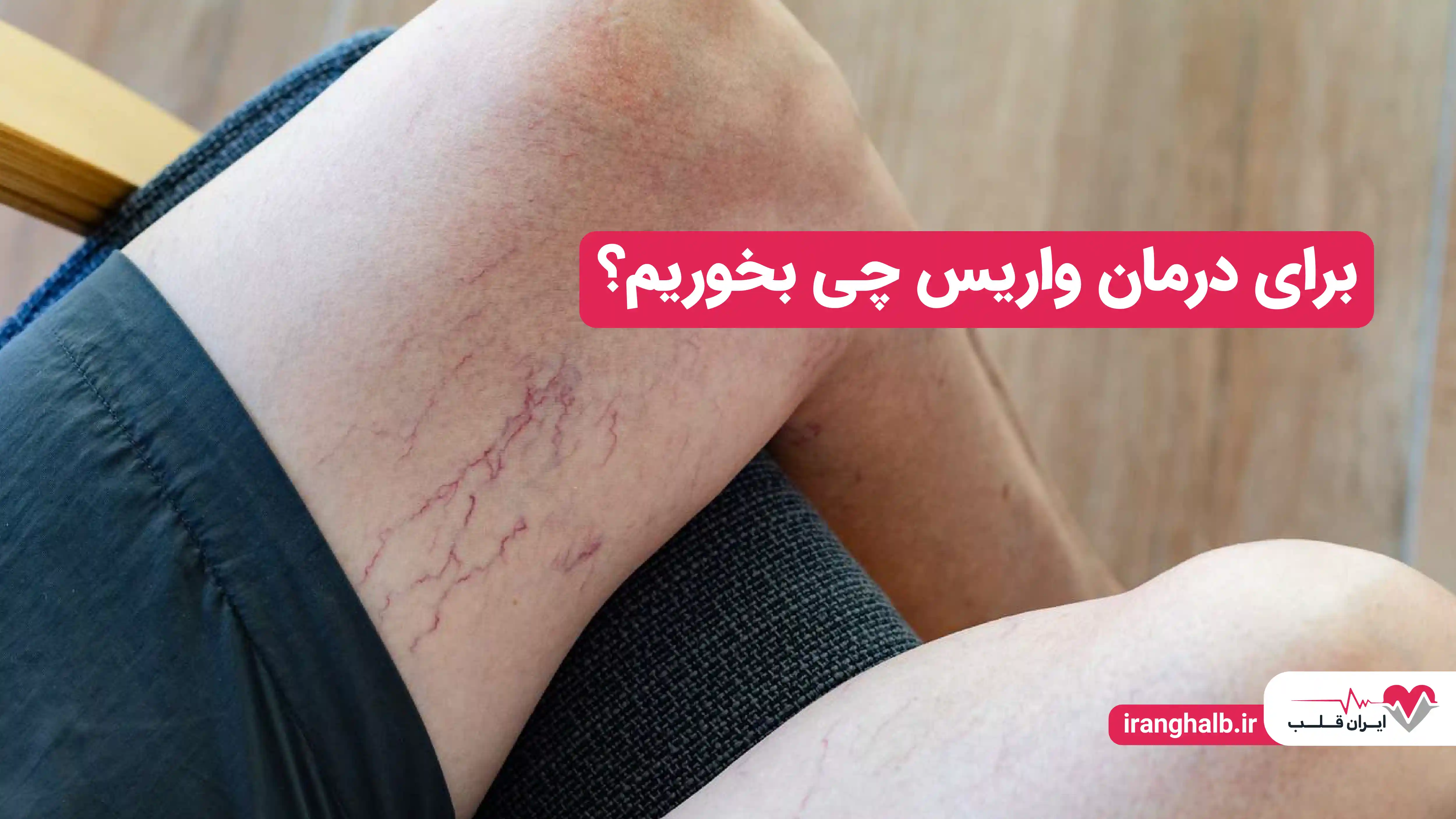 برای درمان واریس چی بخوریم؟ برای درمان واریس چی بخوریم؟