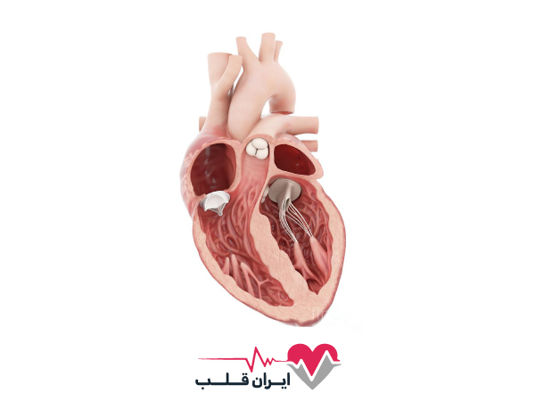 دریچه قلب مصنوعی چیست و کاربرد دریچه قلب مصنوعی