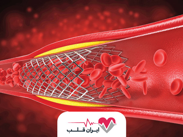 فنر قلب یا استنت قلب چیست و چه کاربردی دارد؟