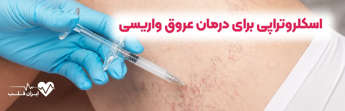 اسکلروتراپی برای درمان عروق واریسی | راهکار مؤثر و
