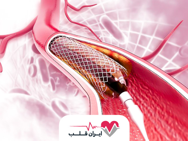 بالن قلب چیست و همه چیز درباره بالن قلب