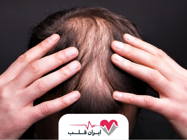 آیا ریزش مو می‌تواند علامت بیماری قلبی باشد؟ بررسی علمی، نشانه‌ها