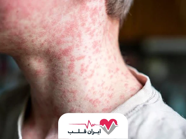 سرخک چیست؟ | آشنایی با علائم و علت بیماری سرخک + راه درمان