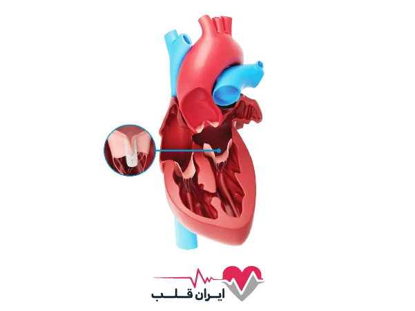 دریچه میترال قلب | هر آنچه باید درباره بیماری‌ها و درمان آن بدانید