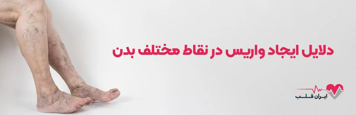 [دلایل ایجاد واریس در نقاط مختلف بدن [از پاها تا صورت 