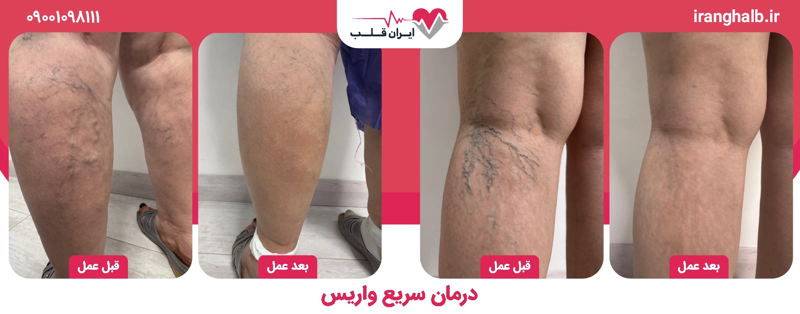 درمان واریس با بهترین متخصص