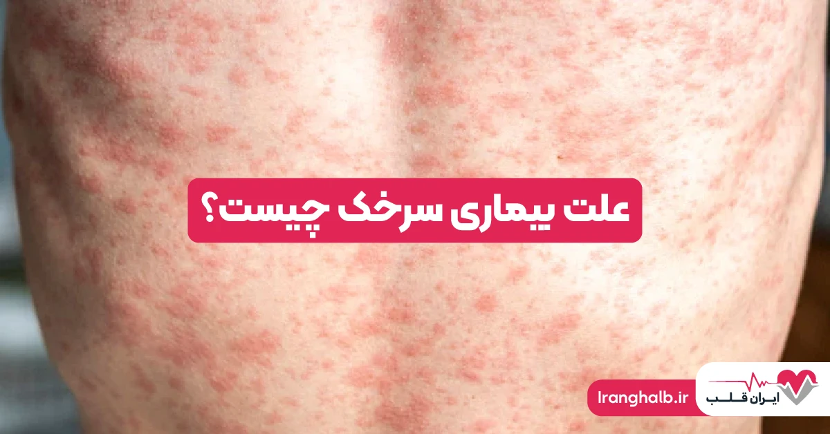 علت بیماری سرخک
