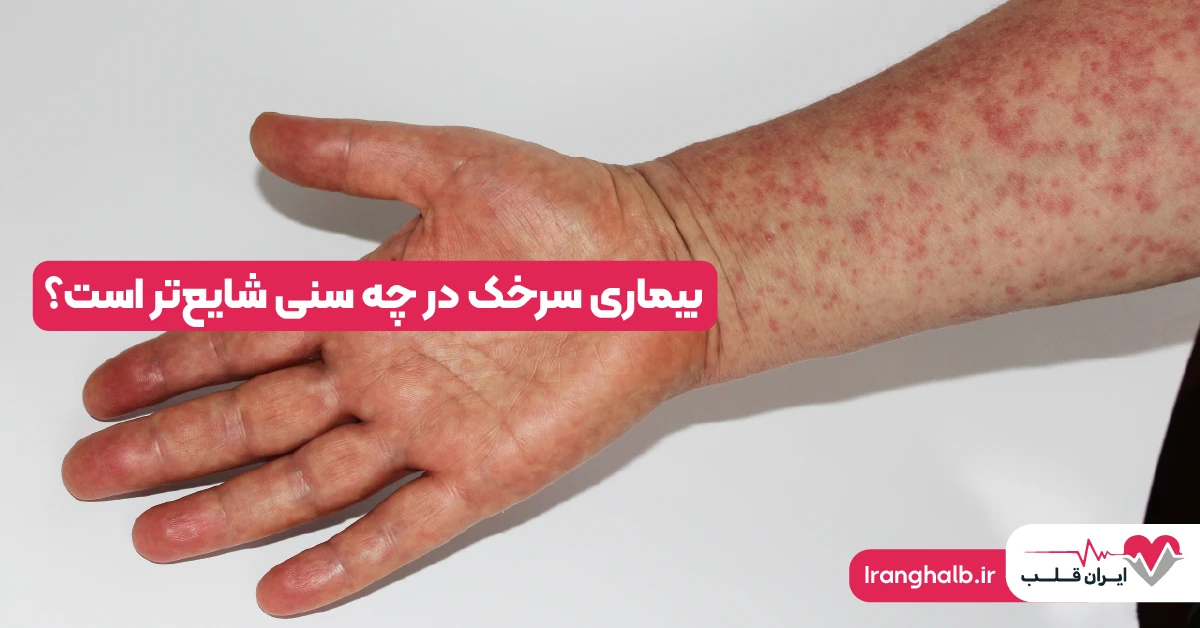 بیماری سرخک در چه سنی شایع‌تر است؟