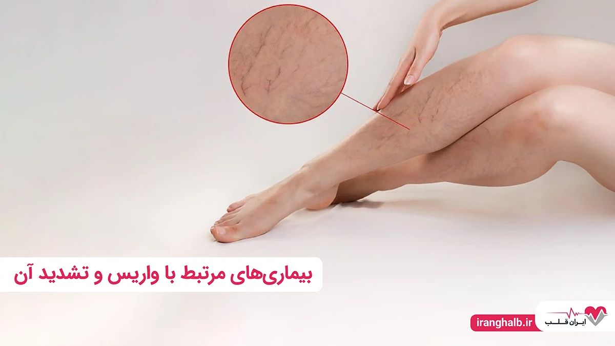 بیماری های مرتبط با واریس و تشدید آن بیماری های مرتبط با واریس و تشدید آن