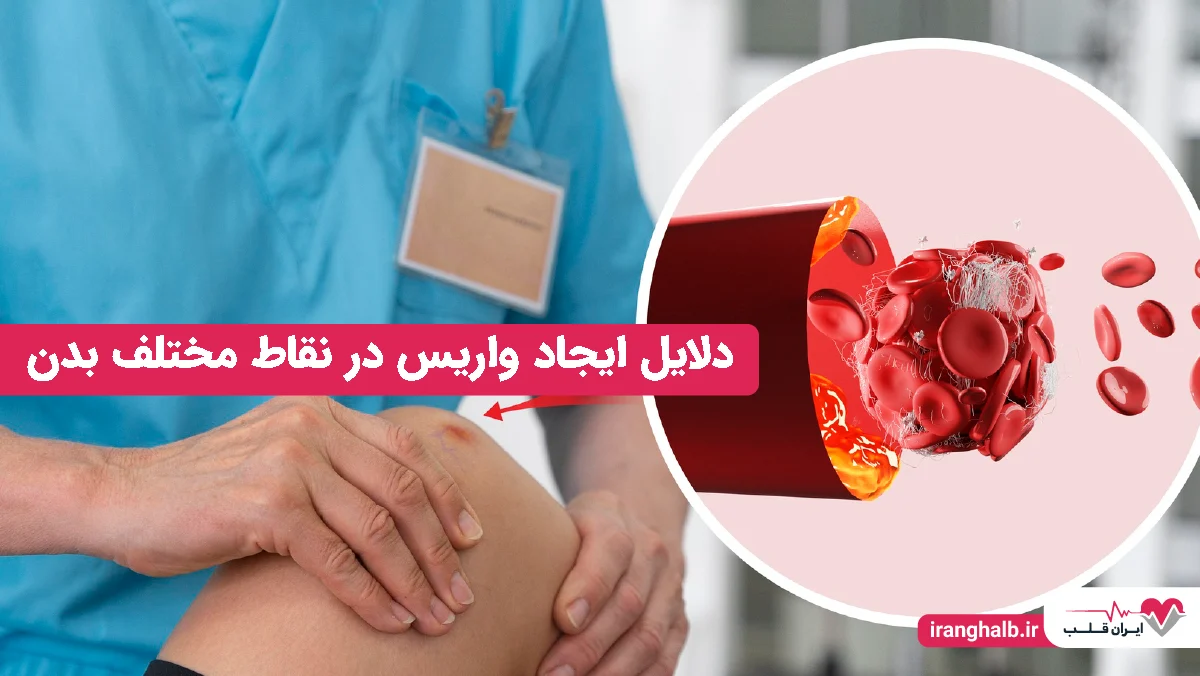 دلایل ایجاد واریس در نقاط مختلف بدن دلایل ایجاد واریس در نقاط مختلف بدن