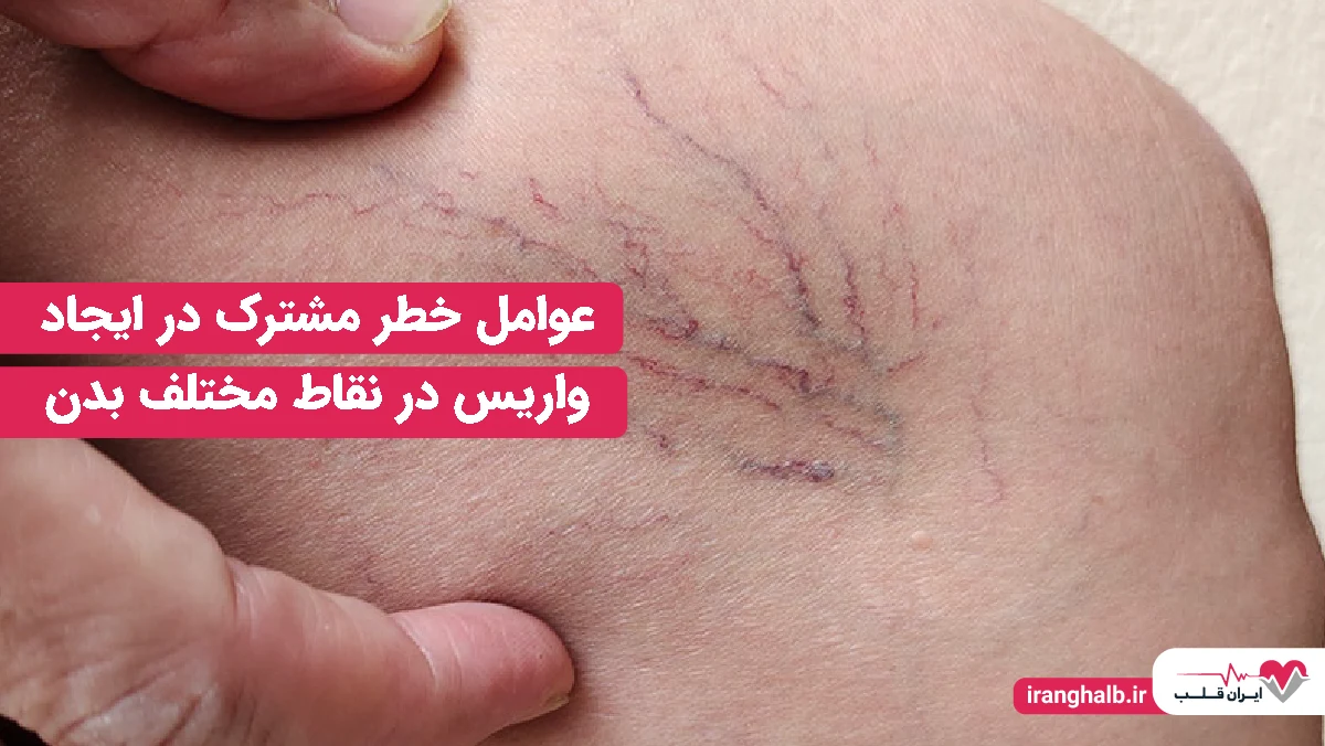 عوامل خطر مشترک در ایجاد واریس در نقاط مختلف بدن عوامل خطر مشترک در ایجاد واریس در نقاط مختلف بدن
