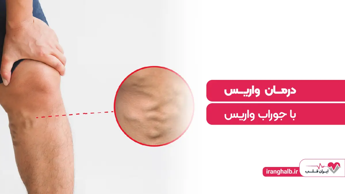 درمان واریس با جوراب واریس درمان واریس با جوراب واریس